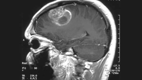 Depriving deadly brain tumors of cholesterol may be their Achilles' heel