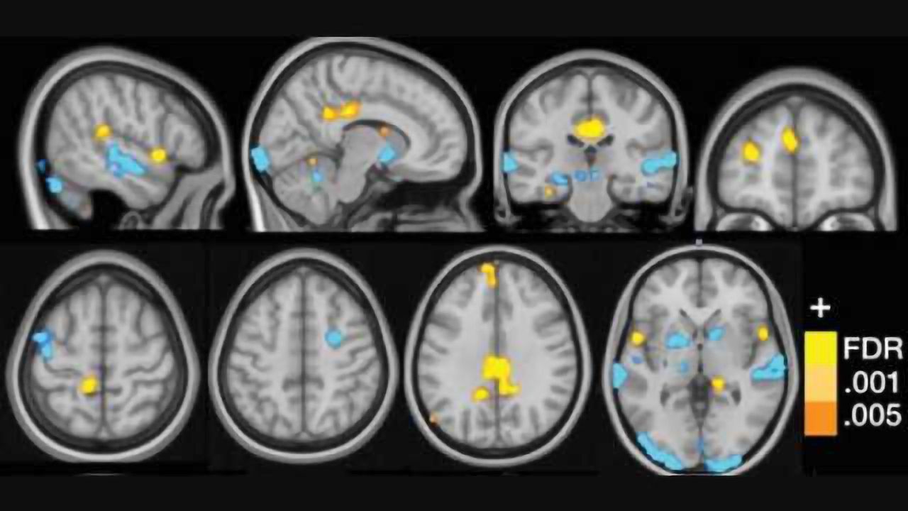 Neural signature for fibromyalgia may aid diagnosis, treatment