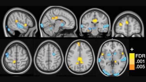Neural signature for fibromyalgia may aid diagnosis, treatment