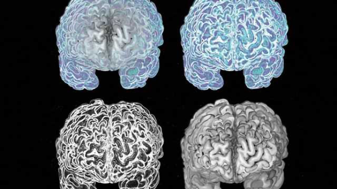 Study uncovers brain changes in offending pedophiles