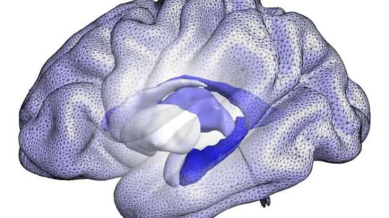 Advanced analysis of brain structure shape may track progression to Alzheimer's disease
