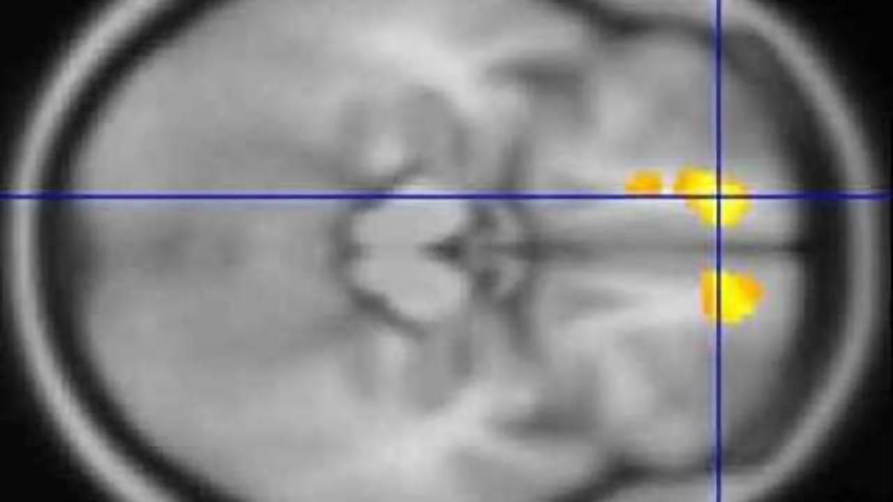 Brain scans of children with Tourette's offer clues about disorder