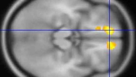 Brain scans of children with Tourette's offer clues about disorder