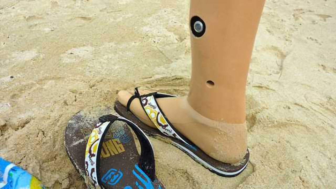 Cause of phantom limb pain in amputees, and potential treatment, identified