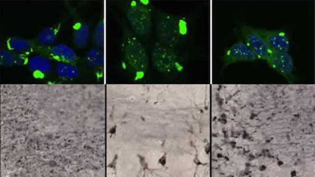 Structure of toxic tau aggregates determines type of dementia, rate of progression