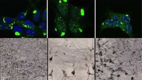 Structure of toxic tau aggregates determines type of dementia, rate of progression