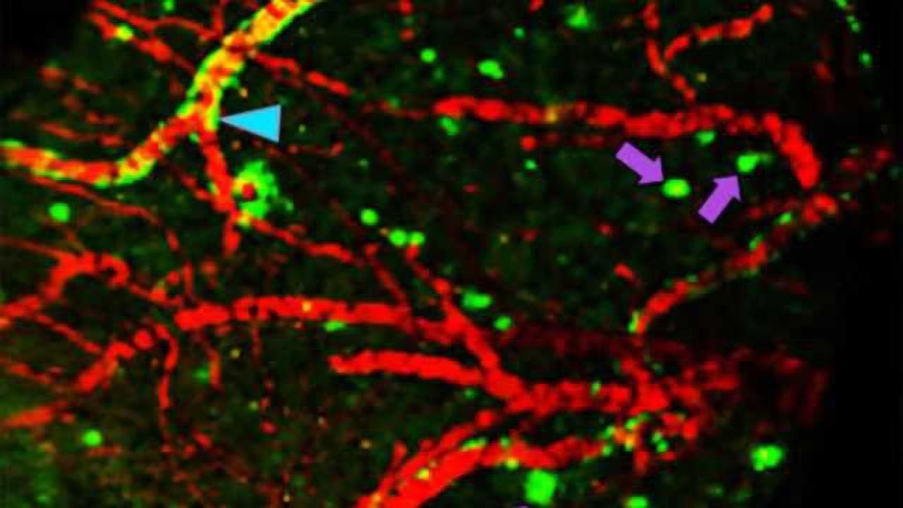 Earlier Alzheimer's diagnosis may be possible with new imaging compound