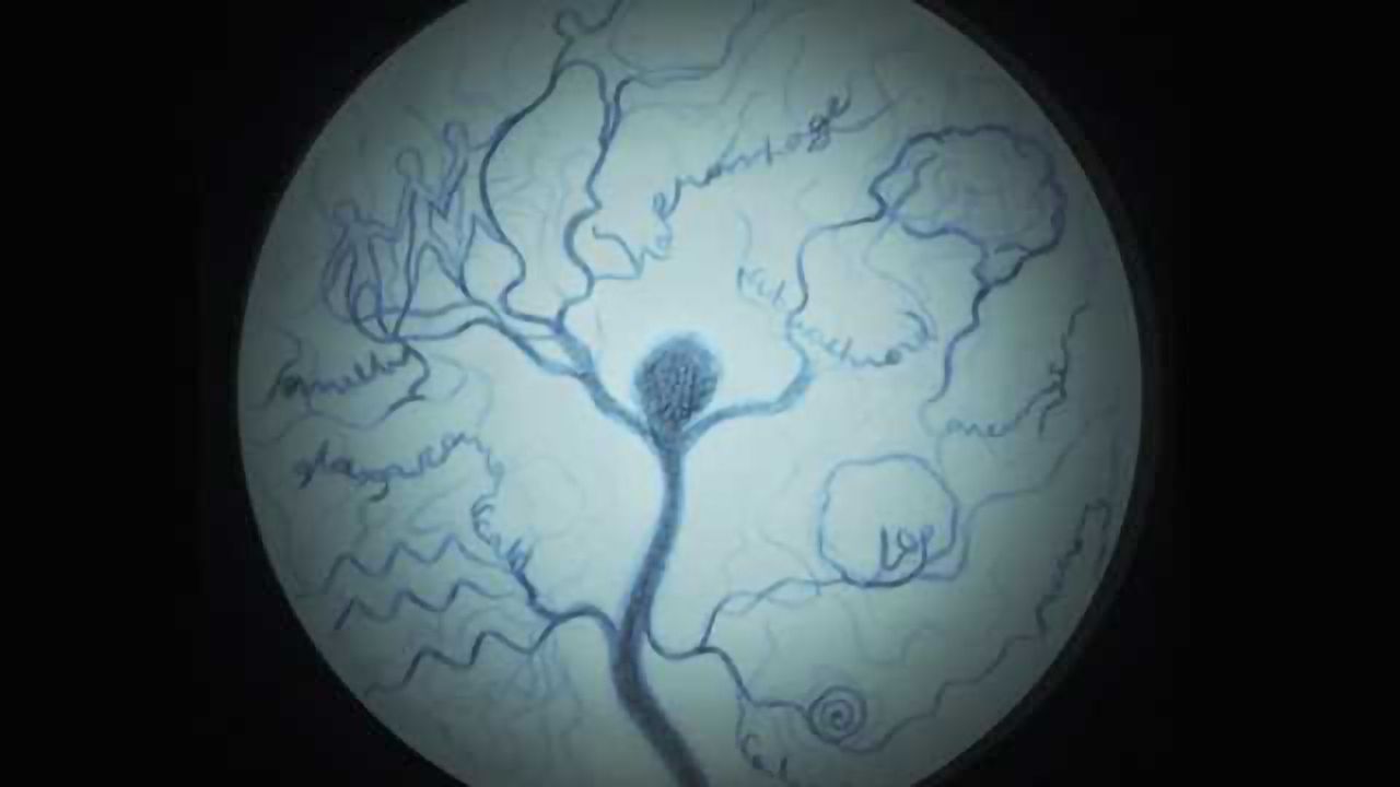 Intracranial aneurysms: The French-Canadian connection