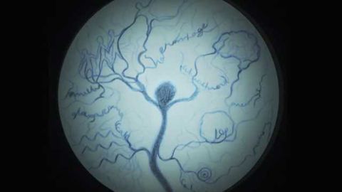 Intracranial aneurysms: The French-Canadian connection