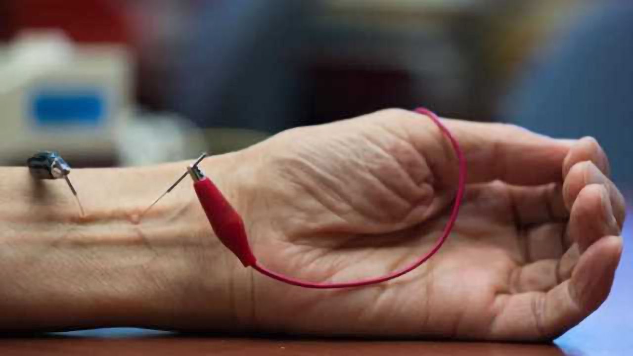 Study finds acupuncture lowers hypertension by activating natural opioids