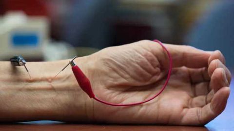 Study finds acupuncture lowers hypertension by activating natural opioids