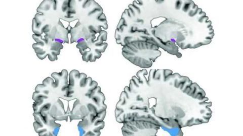 Study challenges model of Alzheimer's disease progression