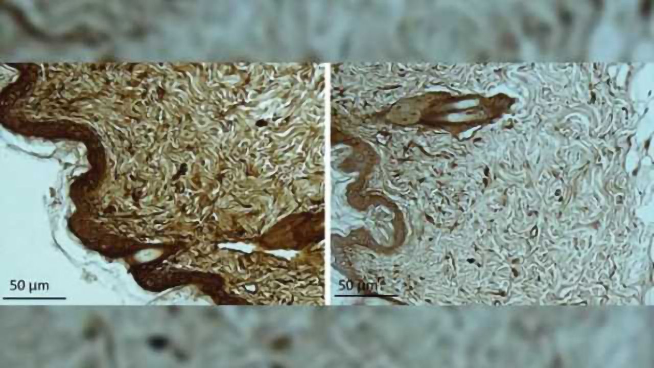 Study identifies new biomarkers for Huntington's disease