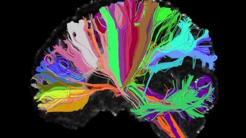 New quantitative technique shows microstructural brain alternations in autism spectrum disorder