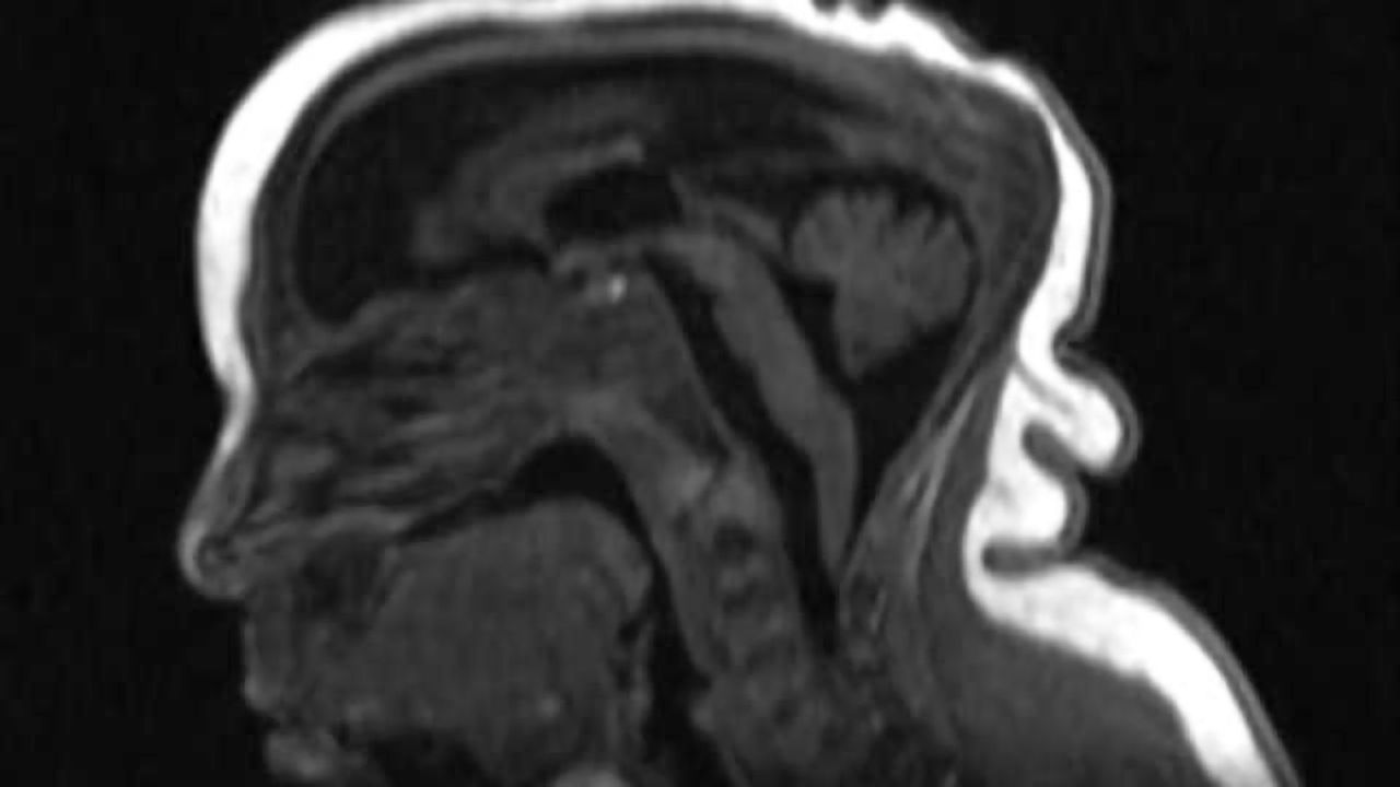 New studies provide more insight into Zika effects
