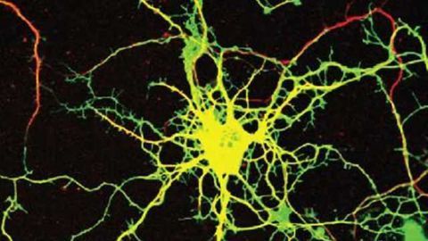 Gene discovered to cause rare, severe neurological disease