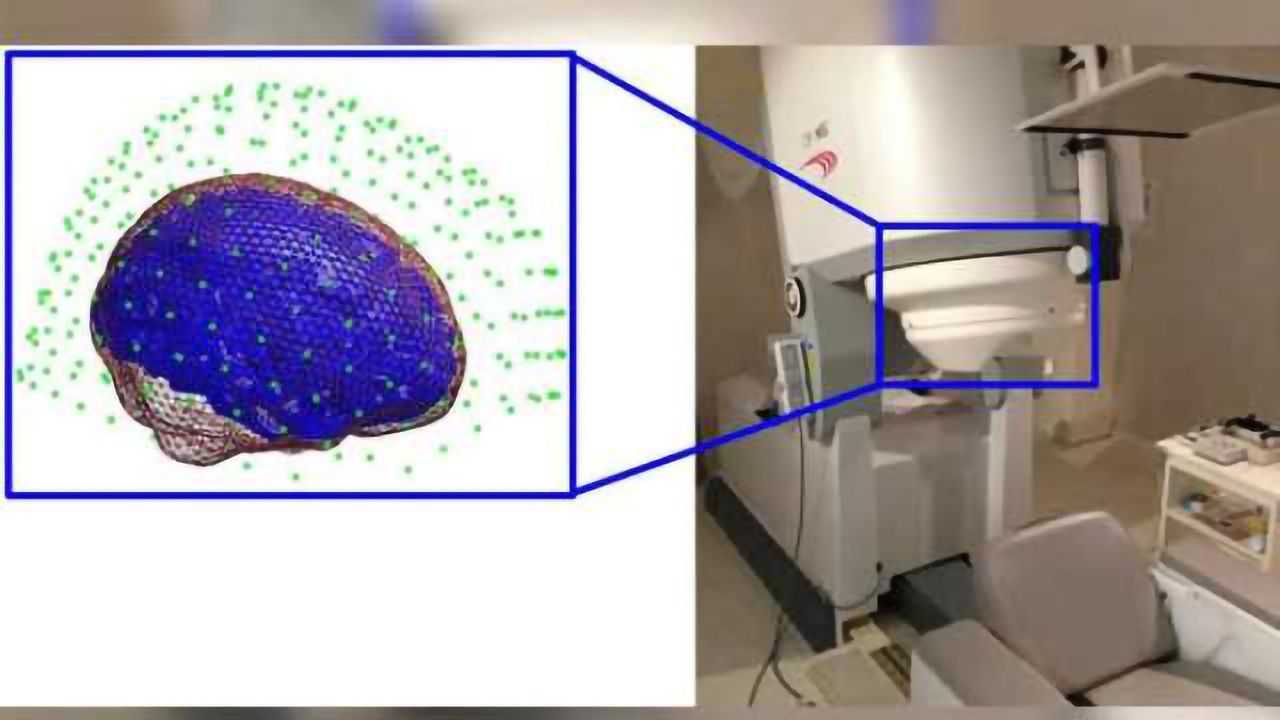 Head impacts lead to brain changes in high school football players