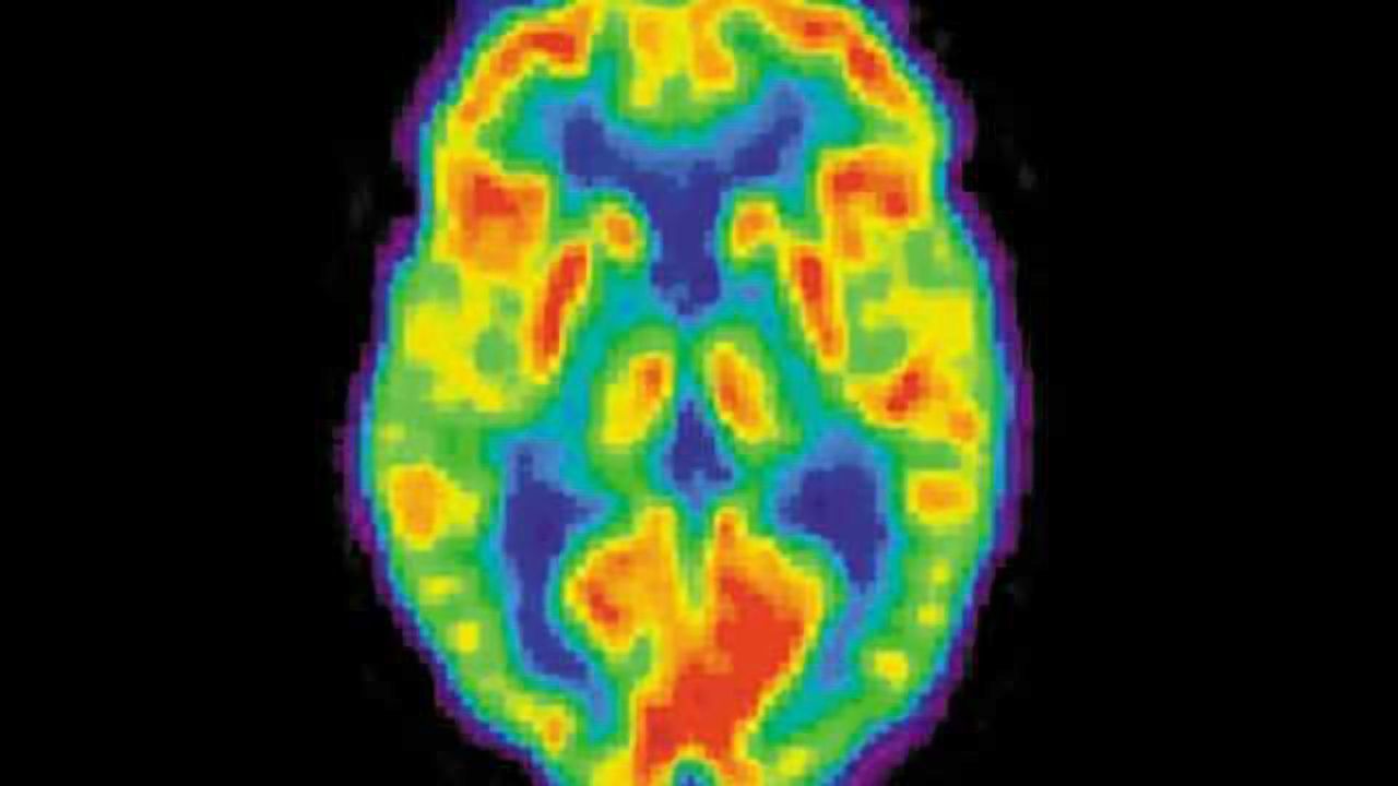 Evidence of brain injury found in young NFL players