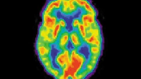 Evidence of brain injury found in young NFL players