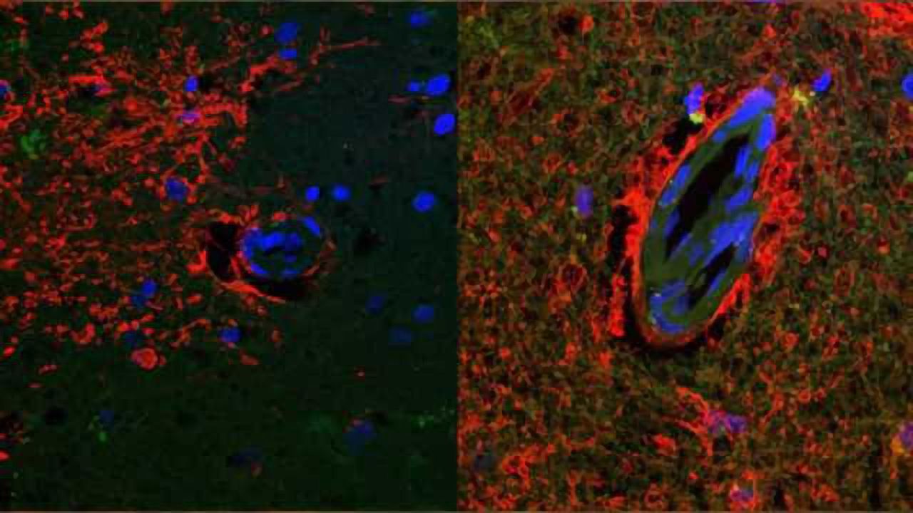 Study suggests possible new target for treating and preventing Alzheimer's