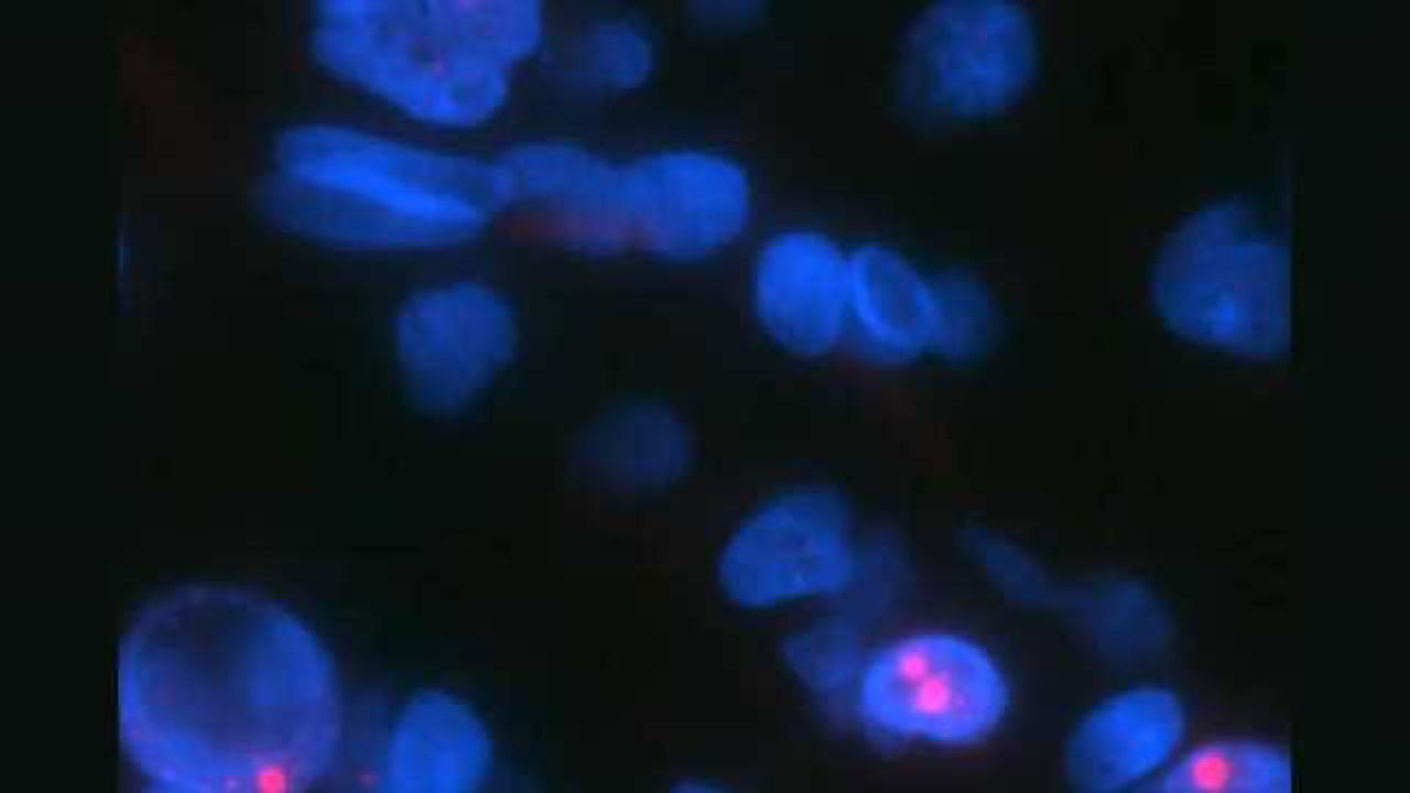 Researchers uncover more genetic links to brain cancer cell growth