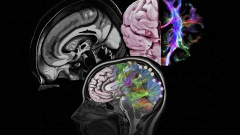 Brains of people with autism spectrum disorder share similar molecular abnormalities
