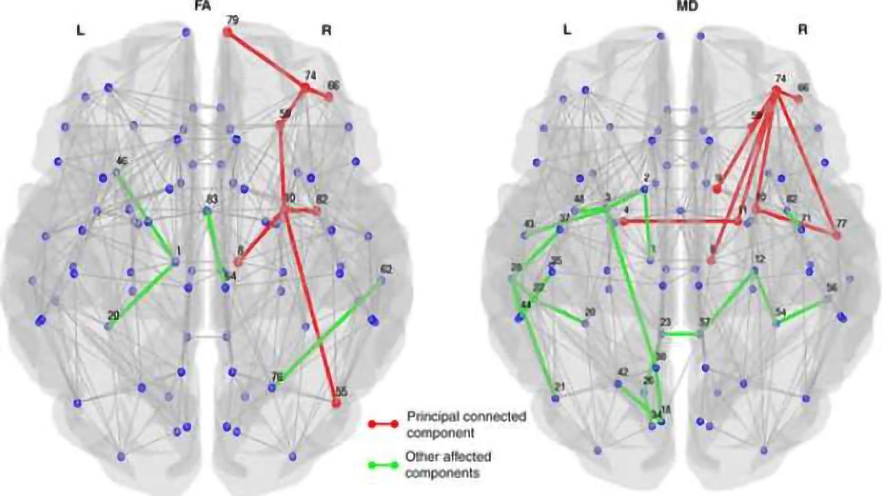 Imaging links structural brain changes and cognitive decline in Parkinson's