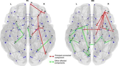 Imaging links structural brain changes and cognitive decline in Parkinson's