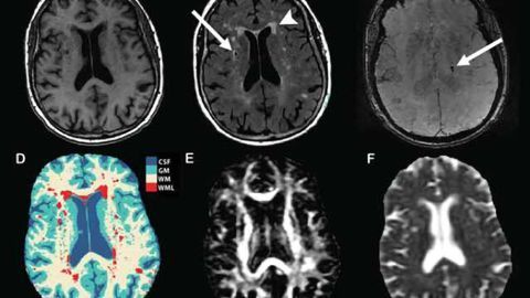 Heart disease protein linked to brain damage