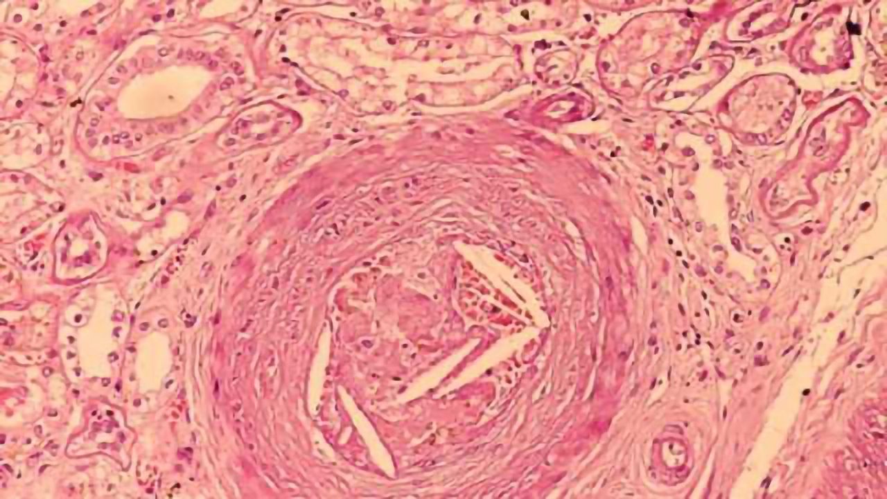 Are cholesterol-lowering statins associated with reduced Alzheimer risk?