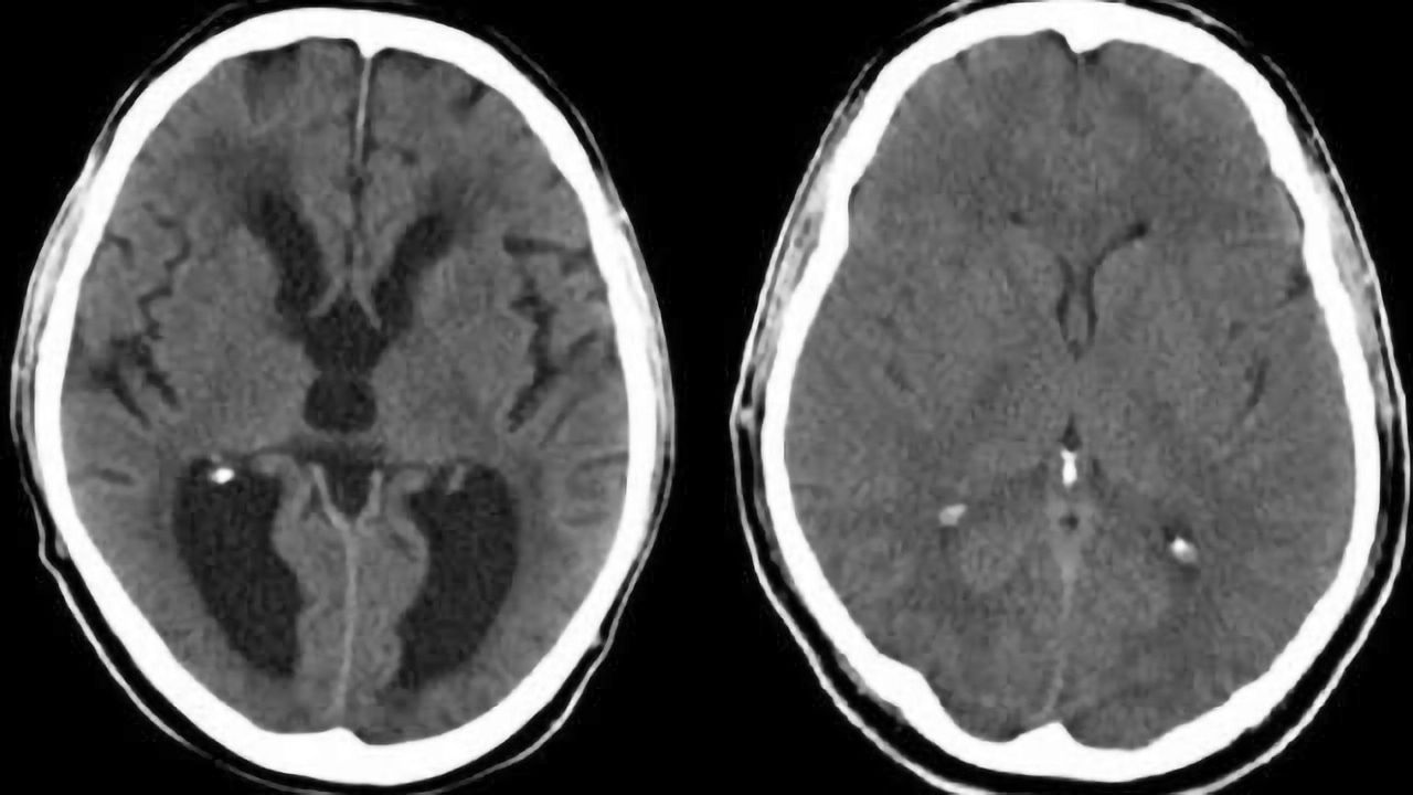 Research identifies a molecular basis for common congenital brain defect