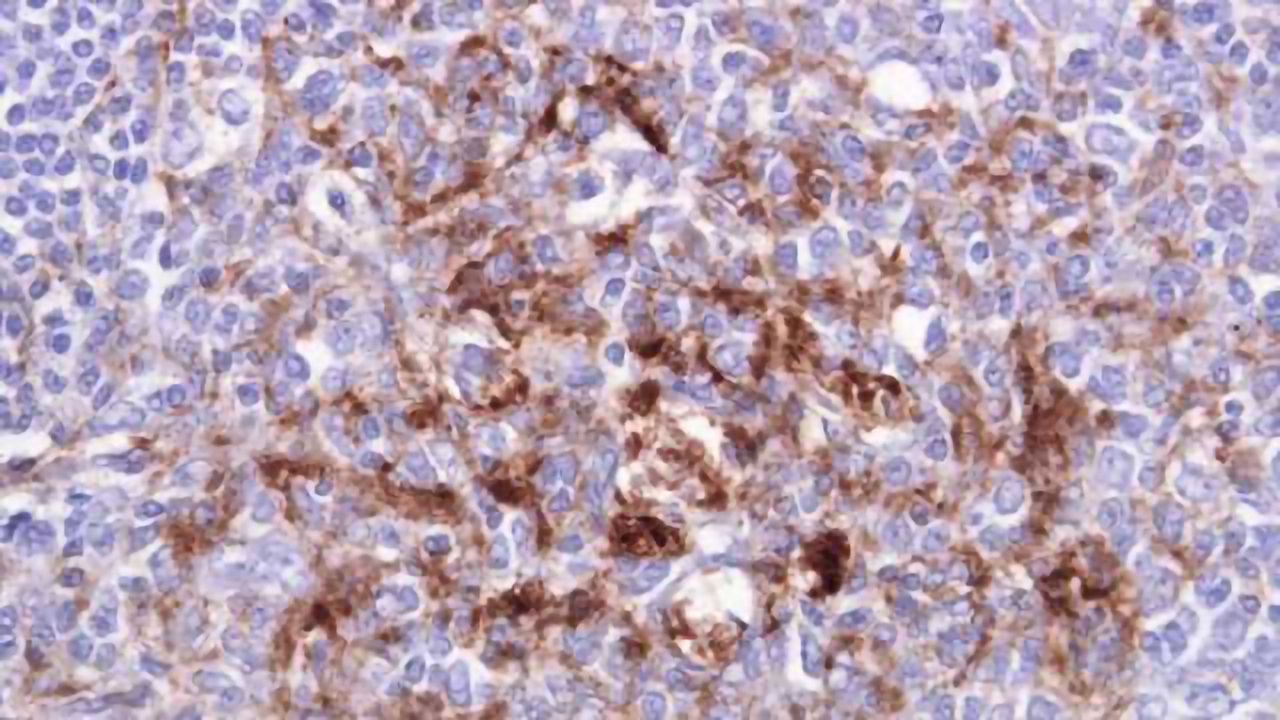 Research could lead to blood test to detect Creutzfeldt-Jakob disease