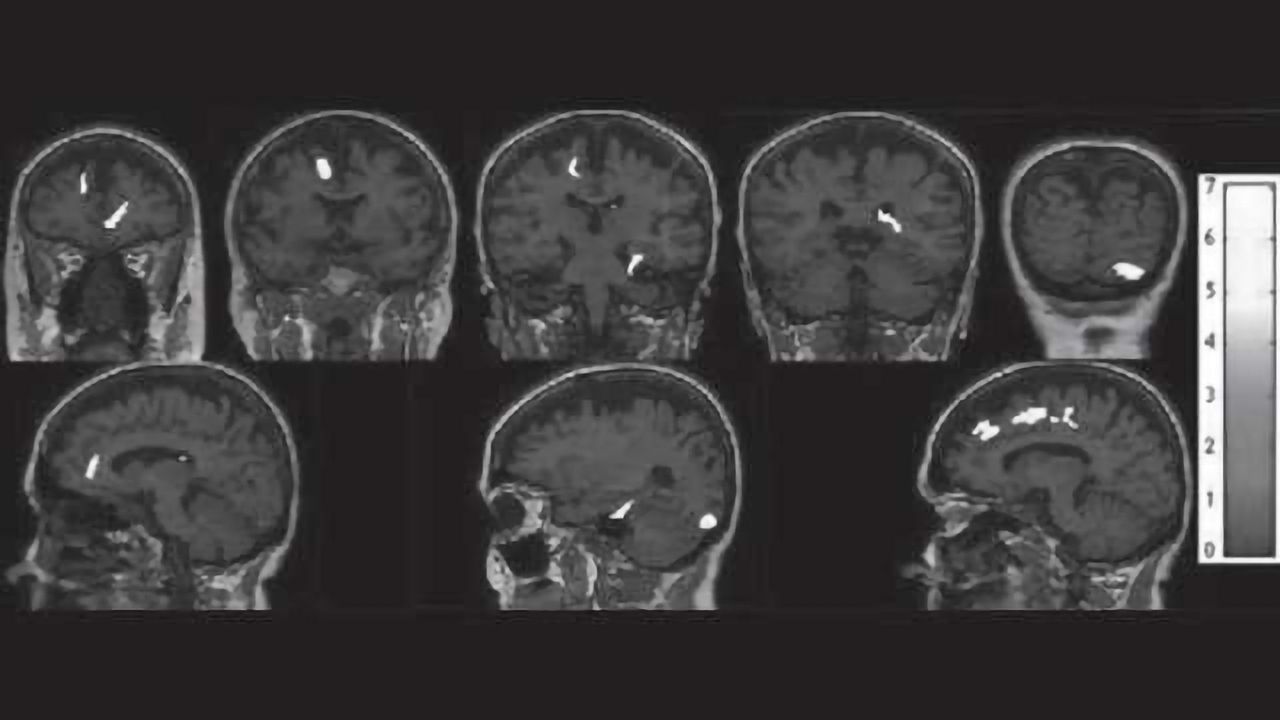 Promising discovery for a non-invasive early detection of Alzheimer's disease
