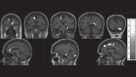 Promising discovery for a non-invasive early detection of Alzheimer's disease
