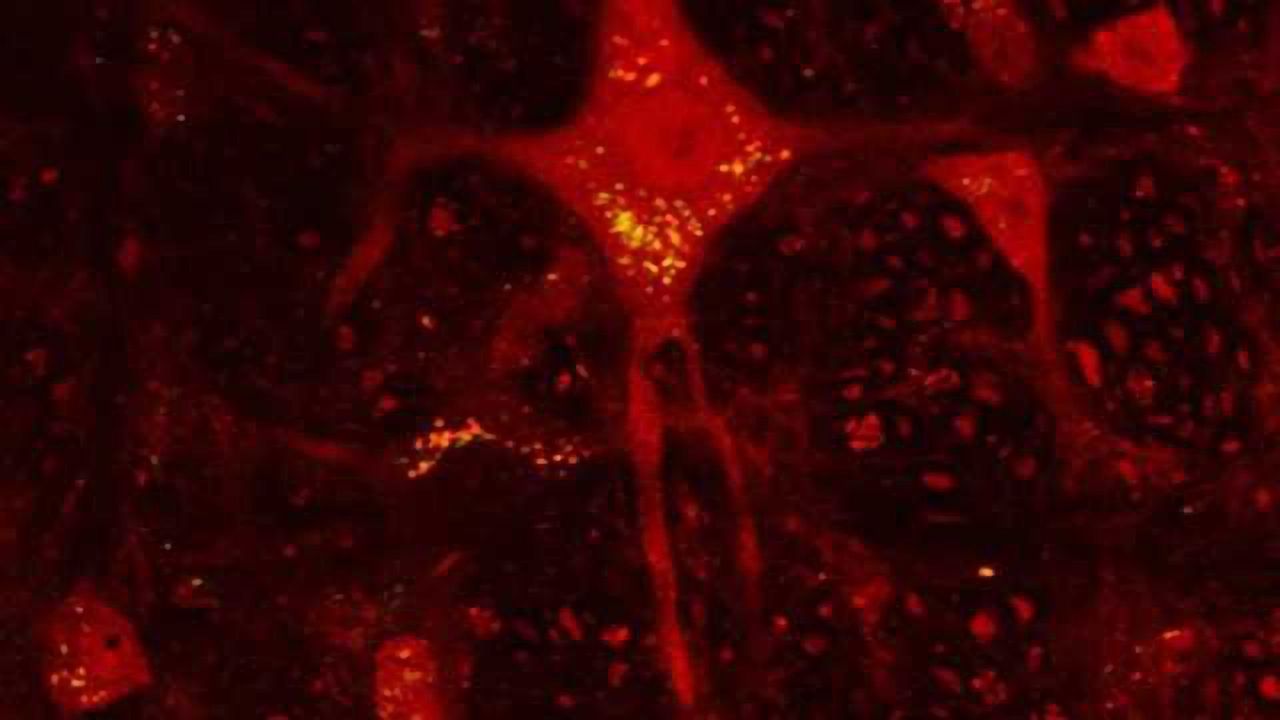 Huntington's disease linked to dysfunction of brain structure