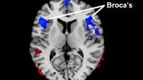 Stuttering linked to reduced blood flow in area of brain associated with language