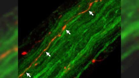 Protein associated with Parkinson's travels from brain to gut