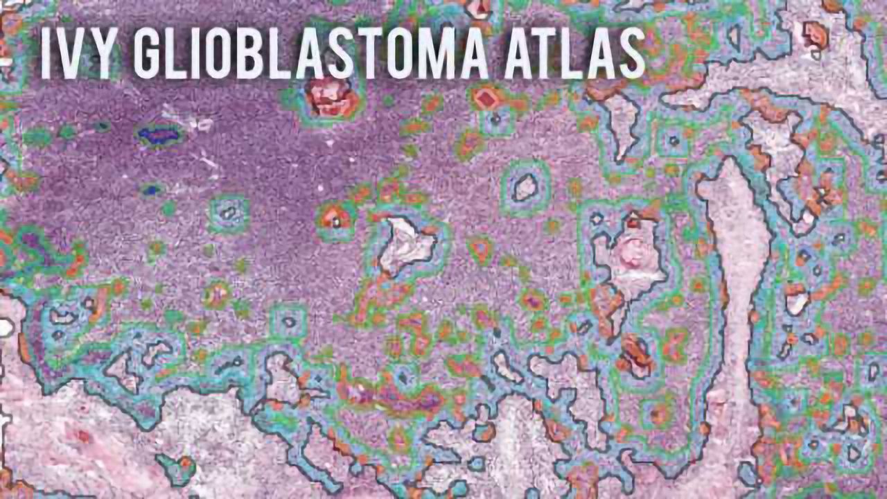 New release of Glioblastoma Atlas sheds light on deadly disease
