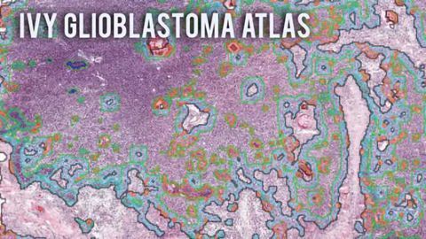 New release of Glioblastoma Atlas sheds light on deadly disease