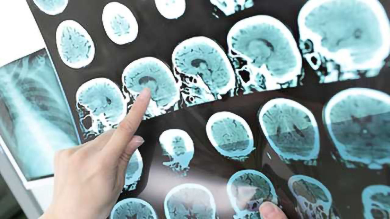 PET imaging for tau visualization in the brain