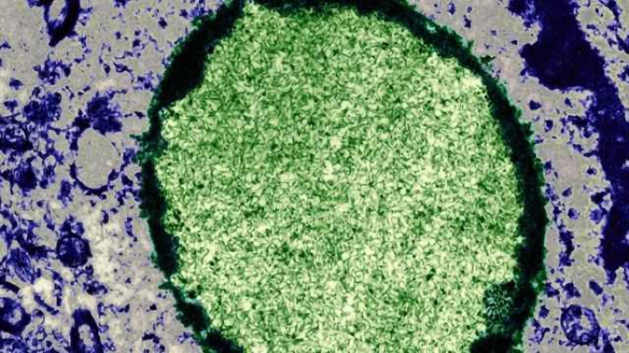 Viral brain infection
