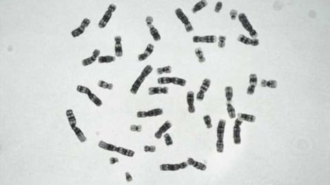Rare genetic disease protects against bipolar disorder