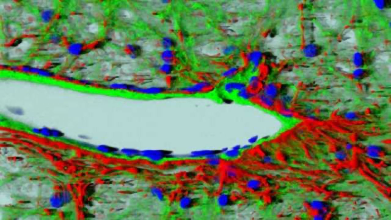 Formation of new blood vessels may explain intractable symptoms of Parkinson's disease