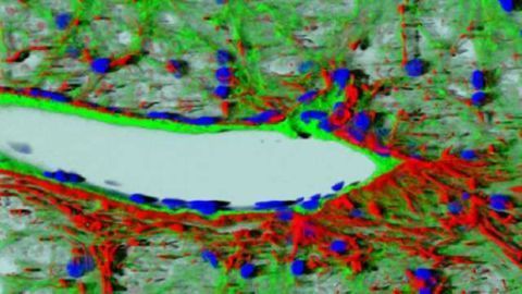 Formation of new blood vessels may explain intractable symptoms of Parkinson's disease