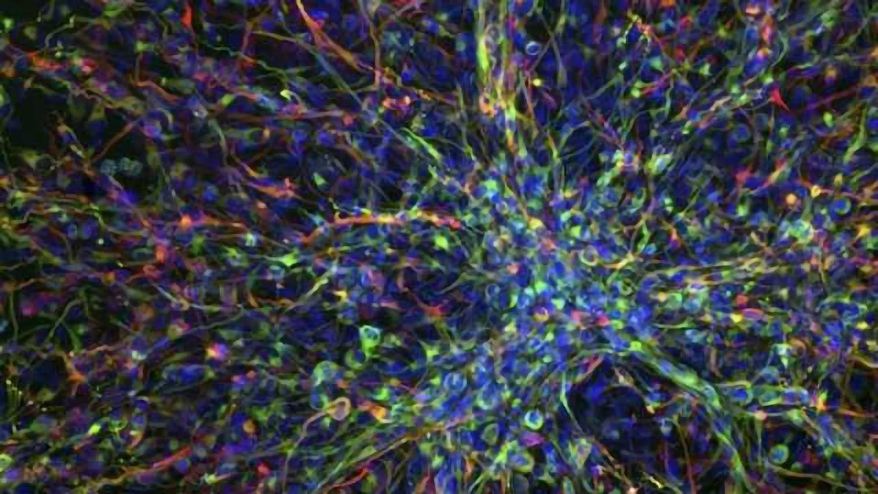 Glioblastoma Multiforme