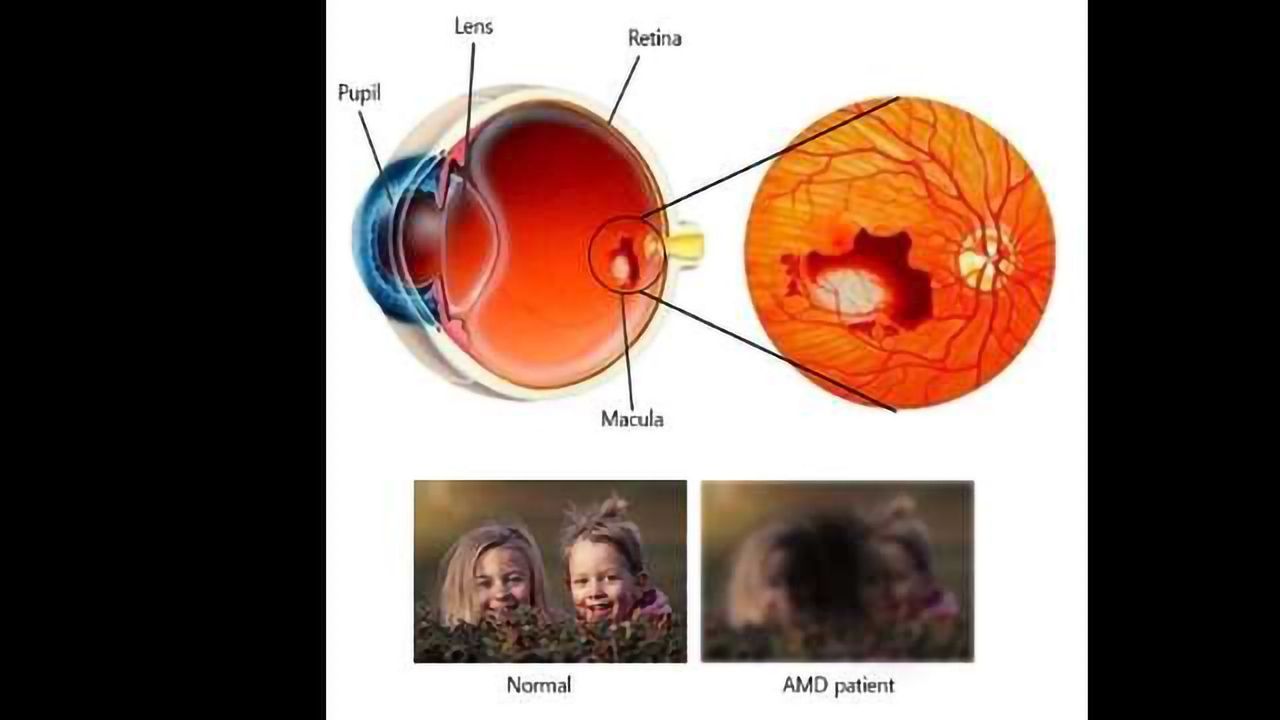 Curing Blindness with CRISPR Genome Surgery
