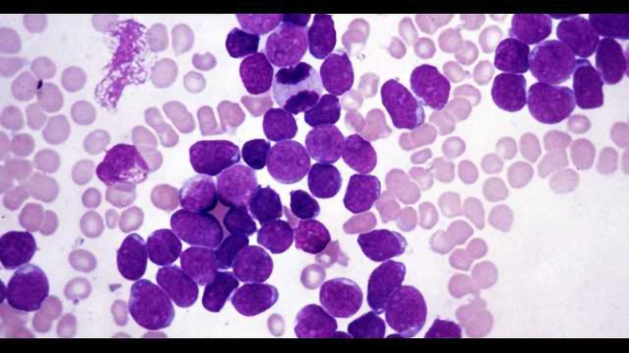 A Model for Dissecting Cancer Progression