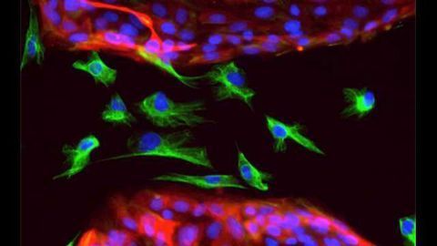 How Do Breast Cancer Stem Cells Resist Chemotherapy?