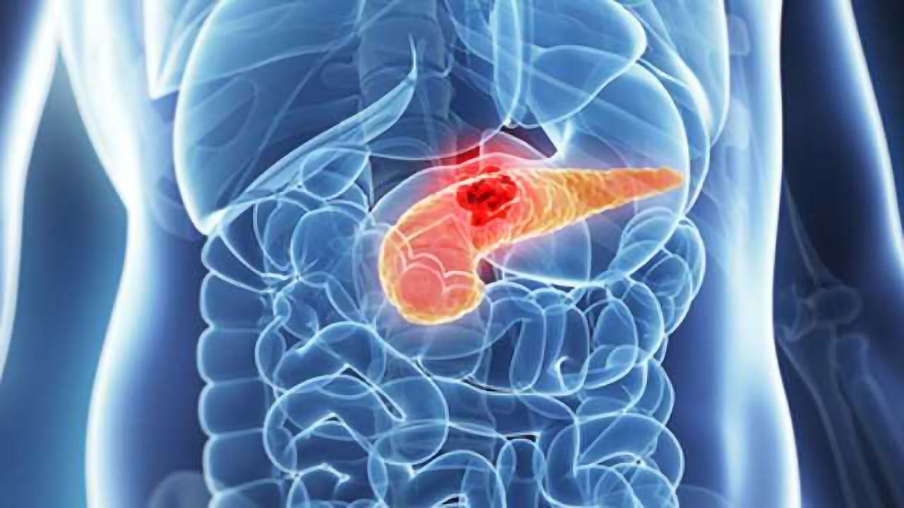 The Key to Pancreatic Cancer Survival