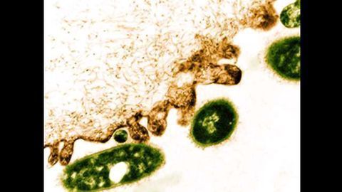 Two Conditions Combine to Cause Severe Infection